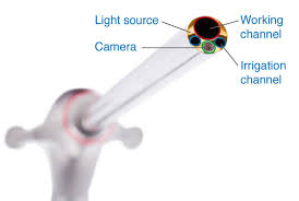 Maybe you would like to learn more about one of these? Endoscopic Spine Surgery Articles Minimally Invasive Procedure