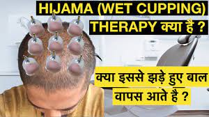 According to maharishi ayurveda, there are three main reasons for hair loss. Hijama Cupping Therapy For Hair Regrowth à¤• à¤¯ à¤‡à¤¸à¤¸ à¤à¤¡ à¤¹ à¤ à¤¬ à¤² à¤µ à¤ªà¤¸ à¤†à¤¤ à¤¹ Genuine Tips Youtube