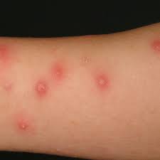 Culicosis Bullosa Altmeyers Enzyklopadie Fachbereich Dermatologie