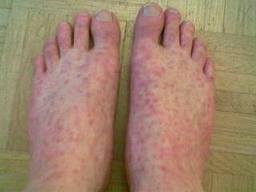 Infection with any hantavirus can produce hantavirus disease in people. June 2011 Natural Unseen Hazards Blog Page 2