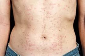 Image result for folliculitis symptoms