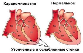 Kardiomiopatiya Klinika 1 Moskva Himki