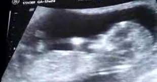 12 Week Old Fetus