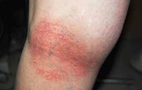 Image result for sweat rash on back
