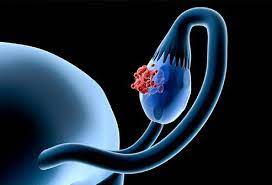 Common types of ovarian cancer. Ovarian Cancer Symptoms Survival Rate Treatment Diagnosis
