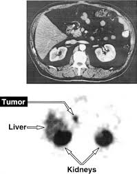 Image result for Primary Tumor Localization