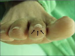 If the cancer has metastasized (spread) amputation of the toe, foot, or limb is necessary and depends on how much the cancer has spread. Glomus Tumor In The Second Toe A Clinical Insight Sciencedirect
