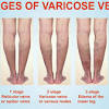 Sclerotherapy is used to treat spider veins, as well as smaller varicose veins. 1