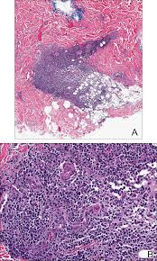 Vincent's hospital, melbourne, vic, australia; Angioimmunoblastic T Cell Lymphoma Mimicking Diffuse Large B Cell Lymphoma Mdedge Dermatology