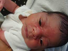 Newborn S Rash Involves Eyes And Nose