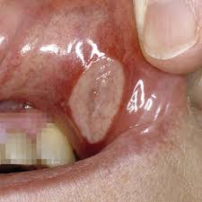 Image result for Canker sores roof of mouth