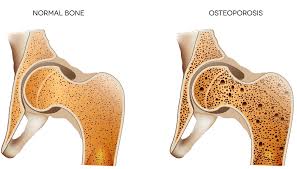Learn about the questions you should be asking about treatment. Osteoporosis Treatment Symptoms Bone Health Msk Australia