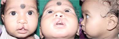 UNILATERAL COMPLETE CLEFT LIP REPAIR: A MODERN MORPHO-FUNCTIONAL SURGICAL  APPROACH