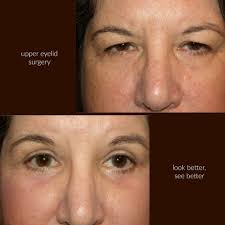 Upper Eyelid Surgery Blepharoplasty Eyelid Eyelift Uppereyelid Uppereyelidsurgery Eye Lazyeye Droopyeyes Dro Upper Eyelid Eyelid Surgery Droopy Eyes