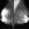 Poland's syndrome is a rare congenital anomaly described by alfred poland in 1897 which is characterize by partial or complete absence of the pectoralis major muscle, ipsilateral symbrachydaktylia and occasionally associated with other malformations of the anterior chest wall. Https Encrypted Tbn0 Gstatic Com Images Q Tbn And9gcqdkbaw8nito Aaeqxzxum1n98swhdzlge1pcji43w Usqp Cau