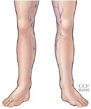 Venous Disease Sclerotherapy