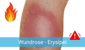 Image result for erysipel photos)