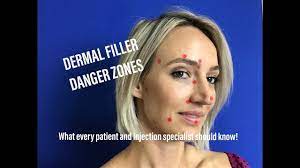Dermal Filler Top 10 Danger Zones Dermal Fillers Danger Zone Facial Fillers