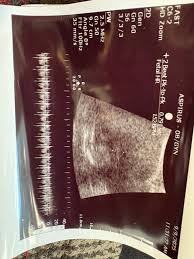 Image result for Friable Cervix