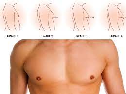 It may be unilateral or bilateral and is diagnosed on examination as a palpable mass of tissue that has been variably defined as >0.5, >1.0 and >2.0 cm in diameter. Gynecomastia Breast Reduction Surgery