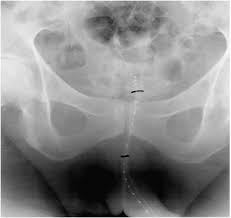 However, as with other types of cancer,. Brachytherapy For Advanced Prostate Cancer Bleeding Prostate Cancer And Prostatic Diseases
