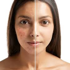 Image result for acne face