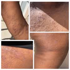 Image result for pruritic urticarial papules and plaques of pregnancy