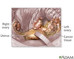 Many things other than ovarian cancer can cause these symptoms. Ovarian Cancer Information Mount Sinai New York
