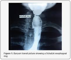 In case of significant obstruction of the esophageal lumen by esophageal web and persistent dysphagia despite iron supplementation, rupture and dilation of the web are necessary. A Plummer Vinson Syndrome Related To Pregnancy And Revealing Oesophageal Tumor