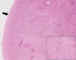 Management and prognosis comparison between incidental and nonincidental  intravenous leiomyomatosis: a retrospective single-center real-life  experience