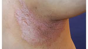 Dec 07, 2020 · intertrigo is common between areas of skin that trap moisture. Inverse Psoriasis Vs Intertrigo What S The Difference