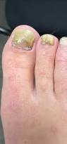 Image result for Onycholysis feet