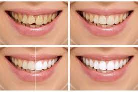 Pin On Dental Treatment