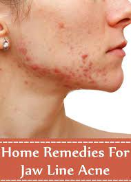 5 Home Remedies For Jaw Line Acne Jawline Acne Neck Acne Pimples On Face