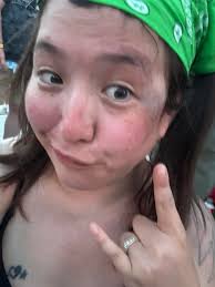 Attendee enjoys music festival despite injury