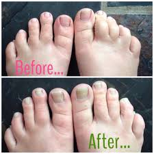 And, well, the listerine makes them smell fresh as a daisy. Trusting The Internet Should I Really Soak My Feet In Mouthwash The Fabulous Fairy