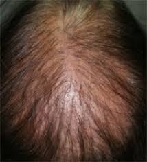 Chutes de cheveux localisées : Lichen Plan Pilaire Alopecies Cicatricielles Dr Abimelec