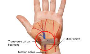 Carpal Tunnel Syndrome Causes Symptoms When To Seek Help Health Plus