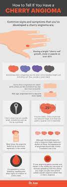 Cherry angioma video follow up: Cherry Angioma Risk Factors Symptoms Natural Treatments Get Collagen Supplements South Africa