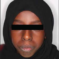 Extraoral photograph of the patient showing (a) convex lateral facial...