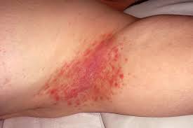 Image result for psoriasis