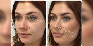 كما يعلم معظم الرجل ، يختلف حجم الذكر. Ø¹Ù…Ù„ÙŠØ© Ø²Ø±Ø§Ø¹Ø© Ø§Ù„Ø°Ù‚Ù† ÙÙŠ Ø¯Ø¨ÙŠ ØªÙƒØ¨ÙŠØ± Ø§Ù„Ø°Ù‚Ù† Ø¯Ø¨ÙŠ ÙƒÙˆØ³Ù…ØªÙƒ Ø³ÙŠØ±Ø¬Ø±ÙŠ