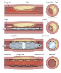 En france, la pose d'un stent a concerné 135 000 personnes en 2013. Infarctus Du Myocarde Ou Crise Cardiaque Causes Symptomes Traitements