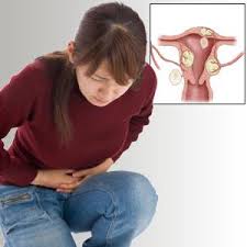 Cyst dan fibroid adalah ketumbuhan yang biasa terjadi kepada wanita. Tanda Tanda Utama Fibroid