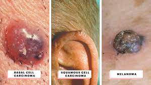 Melanoma skin cancer is the 5th most common cancer overall in the uk. What Does Skin Cancer Look Like A Visual Guide To Warning Signs Allure