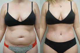 However, an average size woman 5'2″ and 135 lbs. Tummy Tuck For Scottsdale Gilbert Az Dr Josh Olson