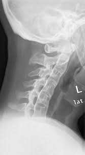Ankylosing Spondylitis Radiology Case Radiopaedia Org Ankylosing Spondylitis Radiology Imaging Radiology