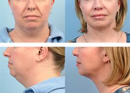 Facetite Necktite Non Surgical Jowl Neck Tightening