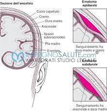 Emorragia cerebrale e ictus emorragico: Cause Dell Emorragia Cerebrale Avvocato Malasanita Errore Medico