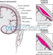 La causa più comune di ictus è l'. Cause Dell Emorragia Cerebrale Avvocato Malasanita Errore Medico